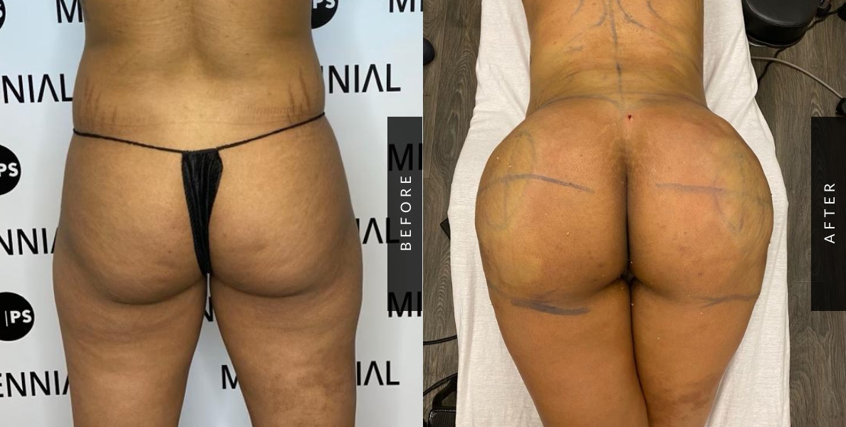 Brazilian Butt Lift Before/After