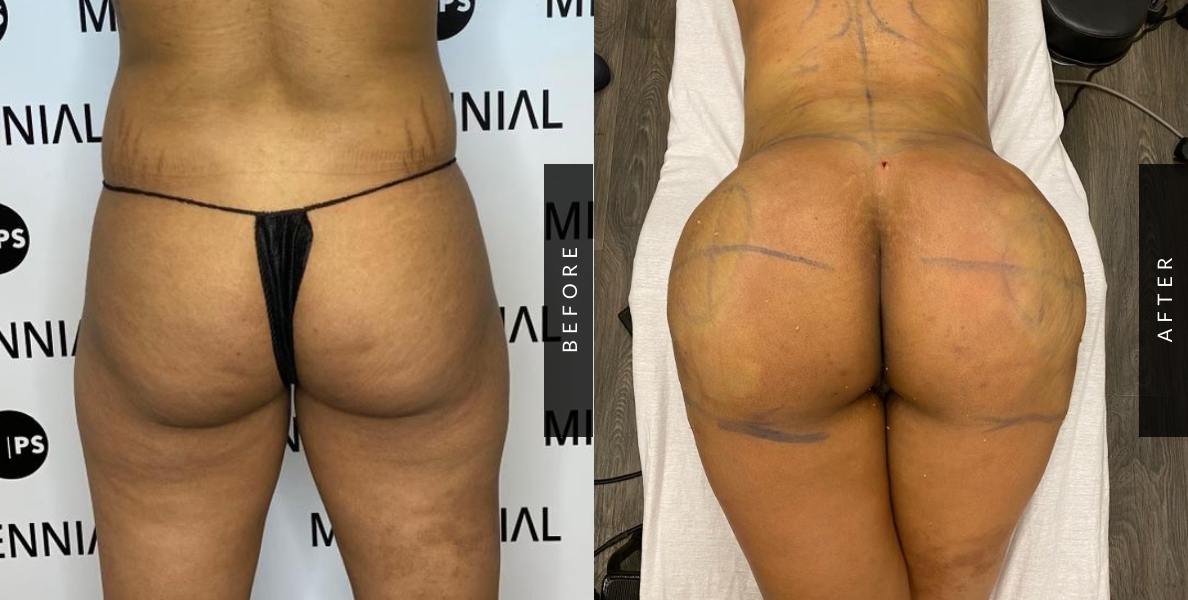 Awake Brazilian Butt Lift (BBL) - Salameh Plastic Surgery Center