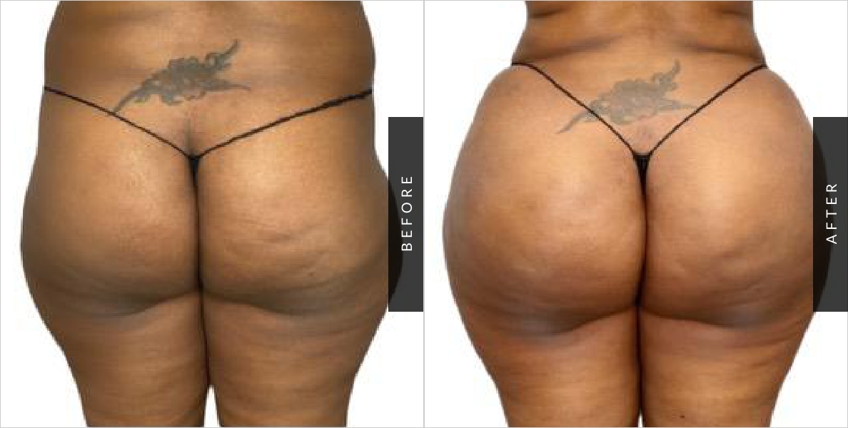 Brazilian Butt Lift Surgery Before-After