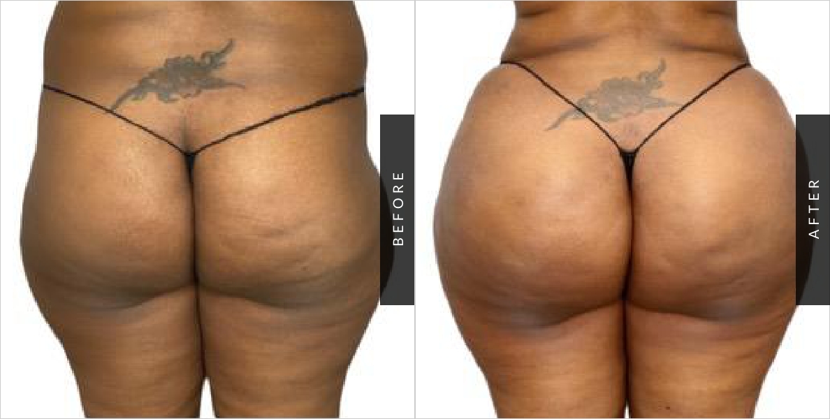 Lower Body Lift Before & After Patient 134, NYC