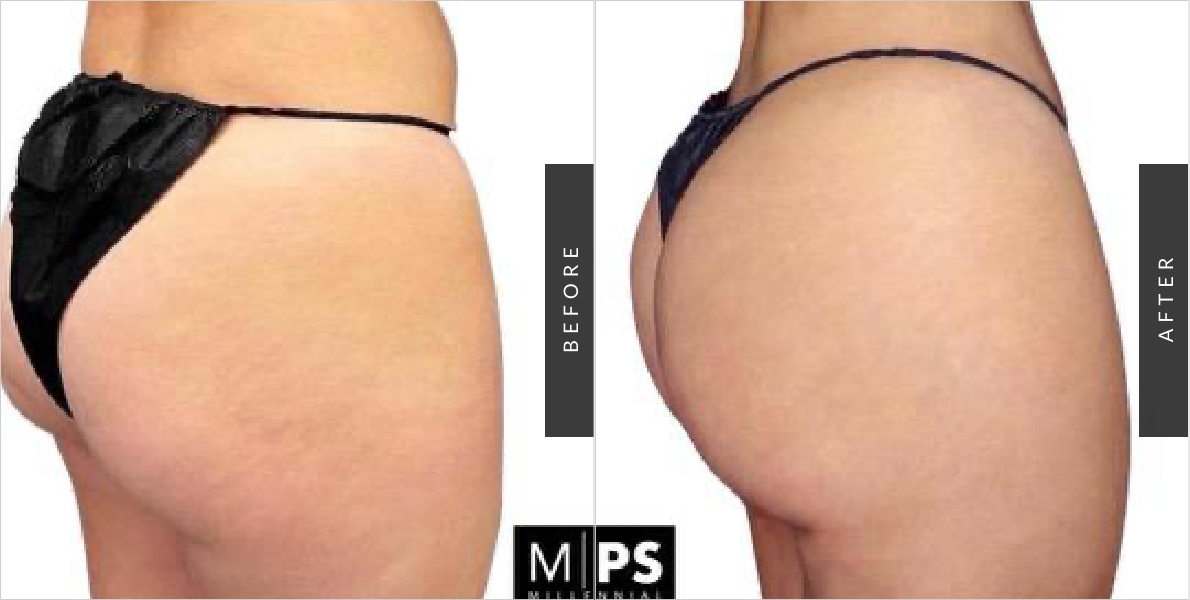 Brazilian Butt Lift Before & After 1