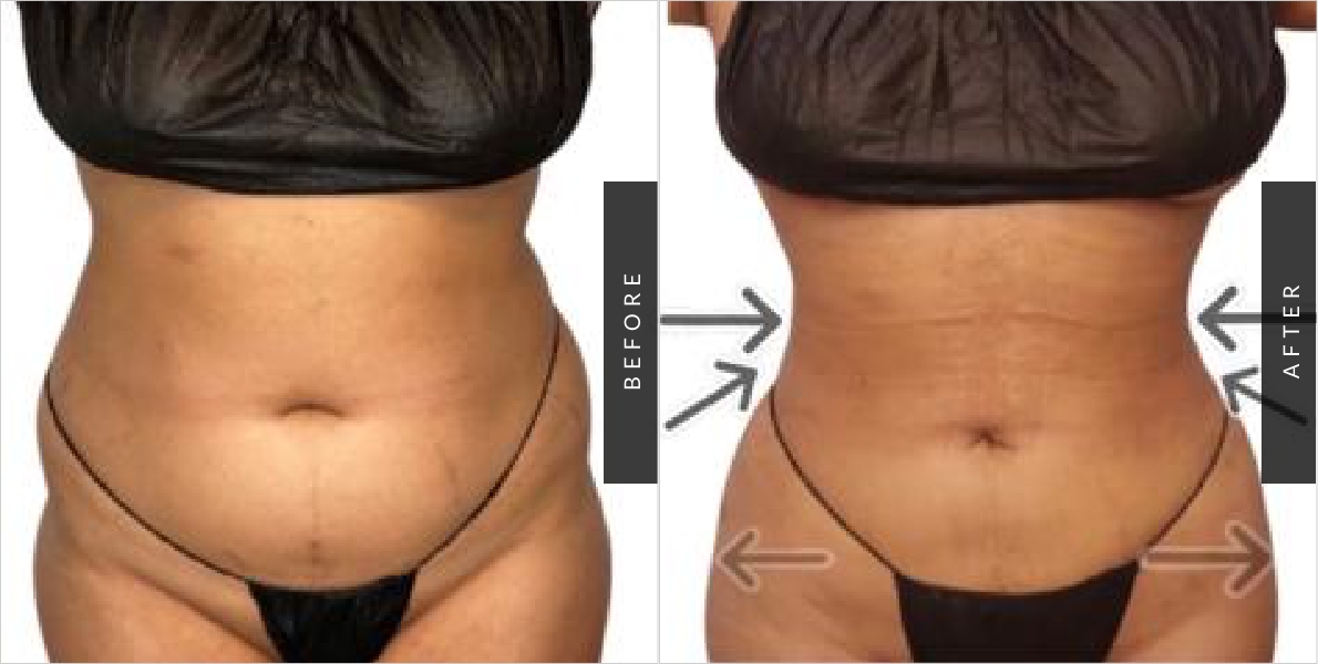 Back Fat Removal - Male & Female - LIPO 360 Before And After