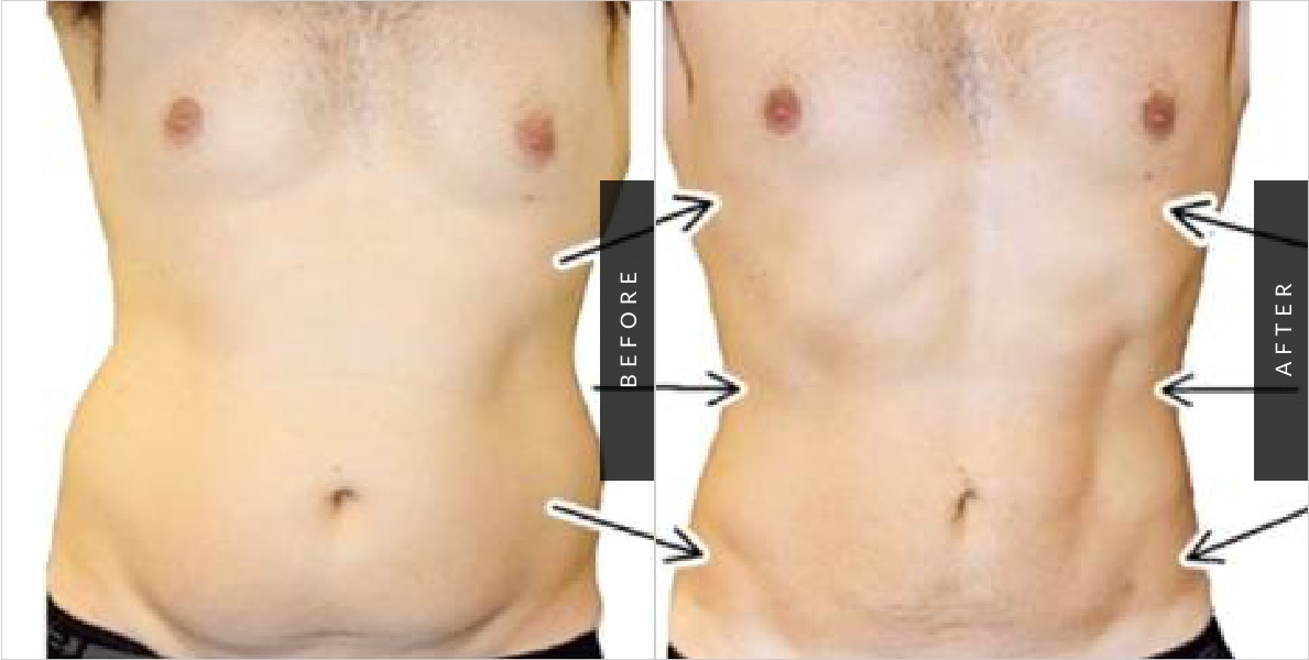 Liposculpture Before & After