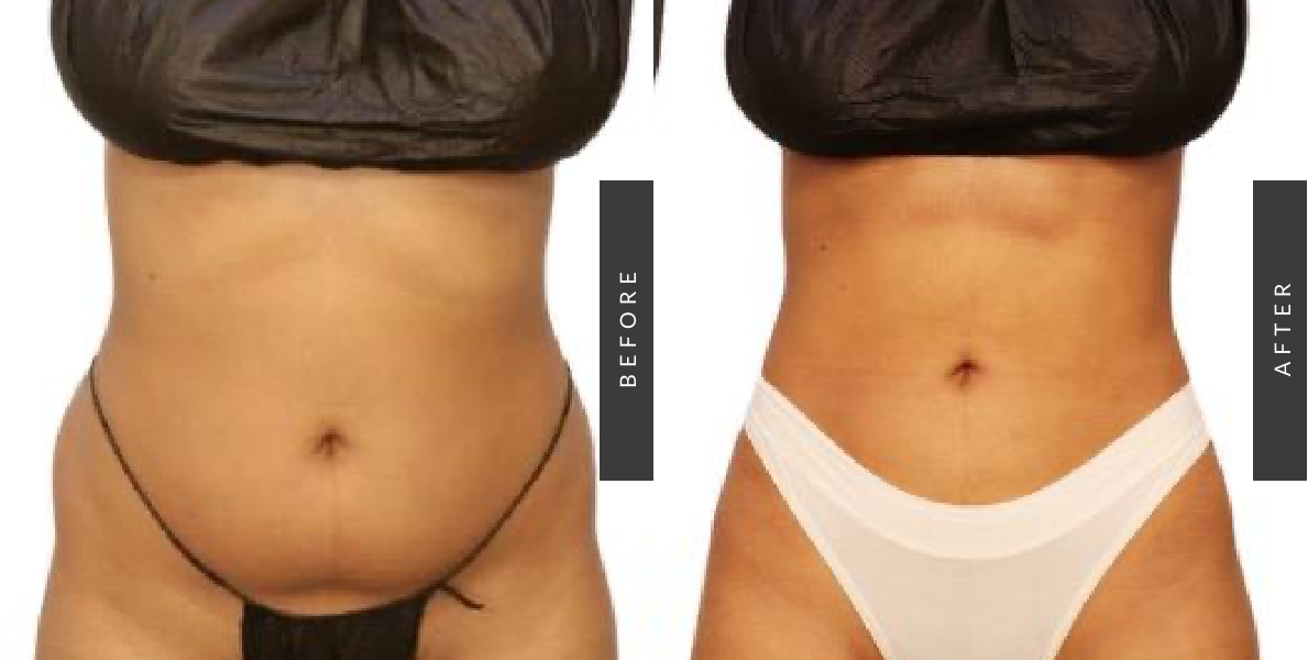 Liposuction Procedure Before-After