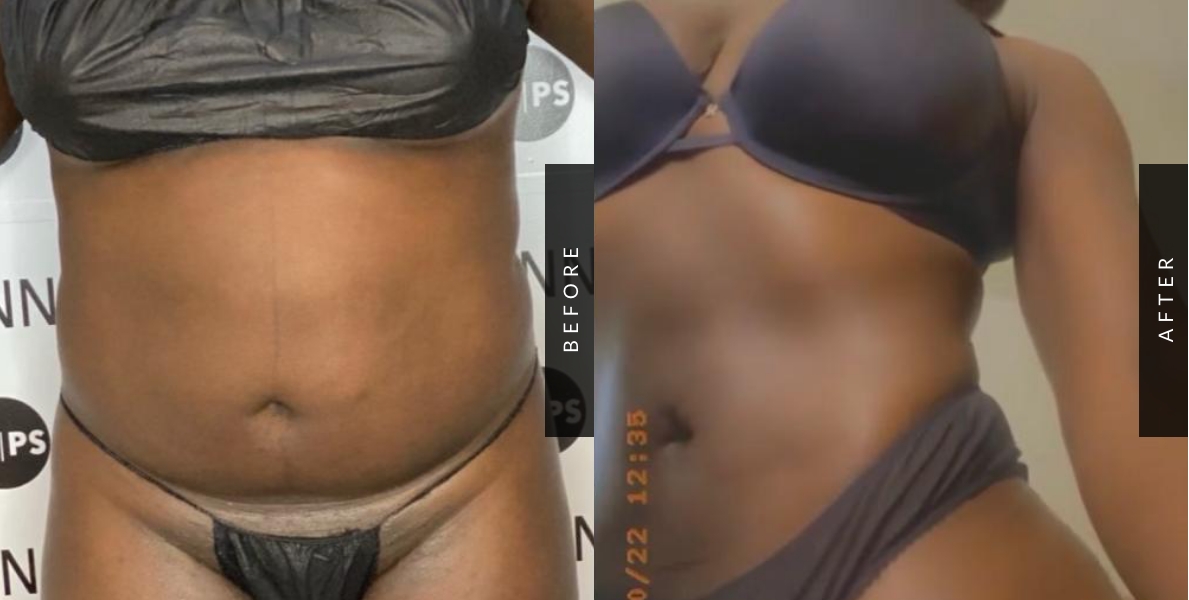 Liposuction Before-After
