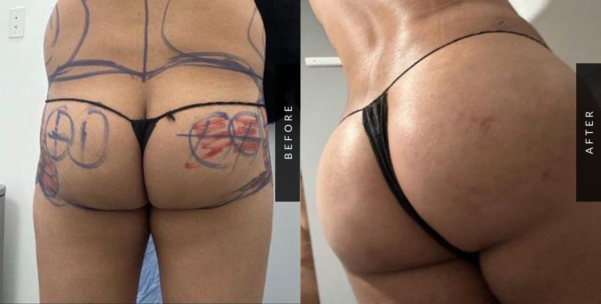 Brazilian Butt Lift Procedure Before & After