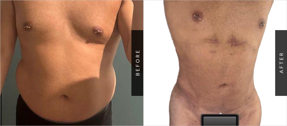 Male Lipo Before-After