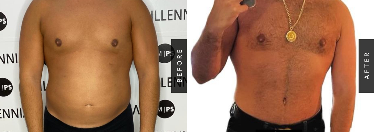 Male Tummy Tuck Before & After Patient 112