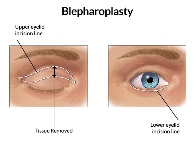 Blepharoplasty