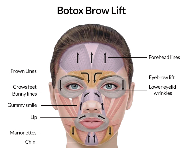 Botox Brow Lift