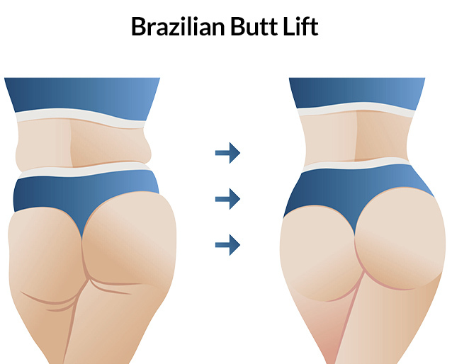 What Side Effects Are Normal After a Brazilian Butt Lift?