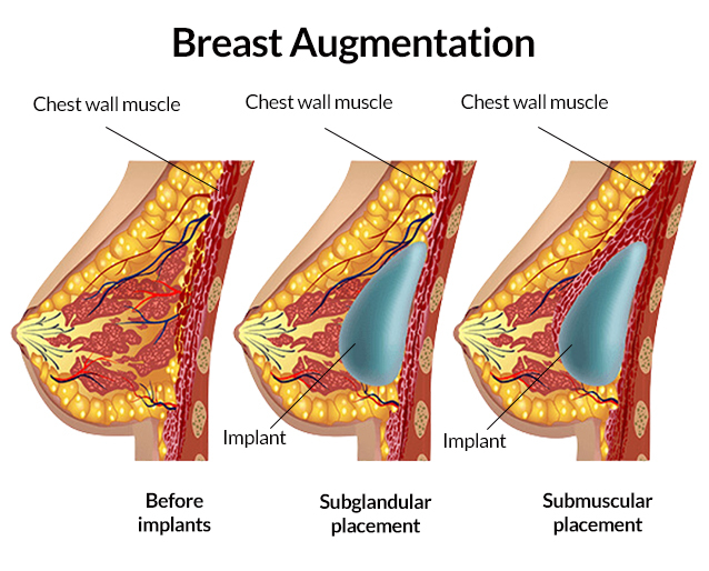 Breast Augmentation Anatomy