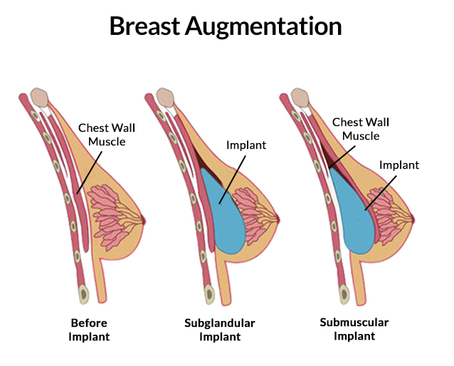 Going From a B to a C Cup with Implants! #breastaugmentation 