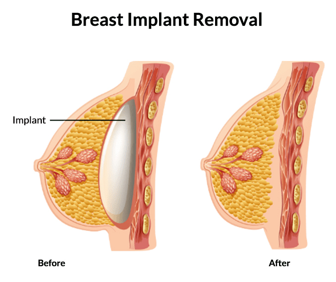 What to Expect From Breast Implant Removal Surgery