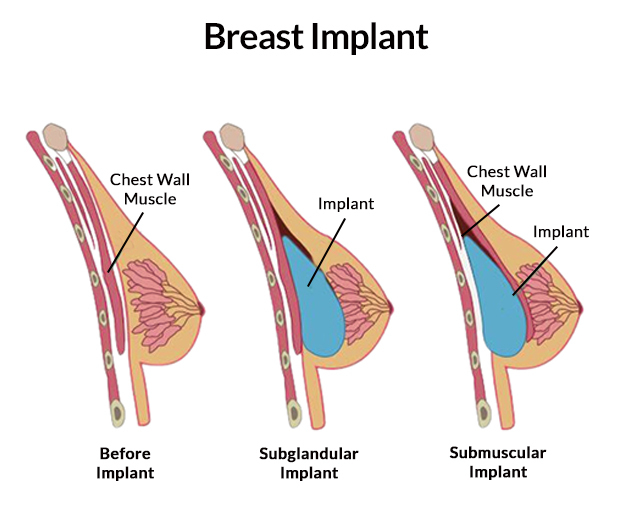 10 Reasons Getting Breast Implants Is Absolutely Worth It