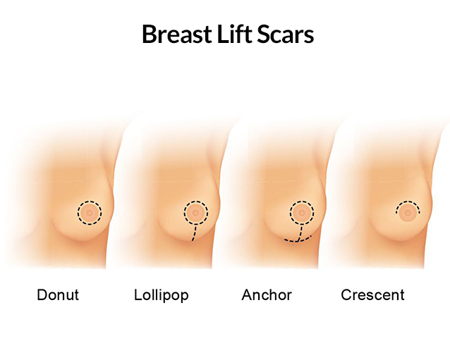 Breast Lift Scars