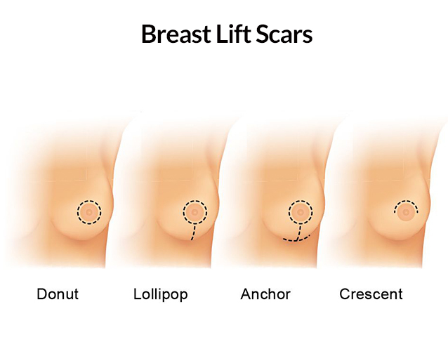 Breast shape before (A, C) and after (B, D) vertical breast reduction.