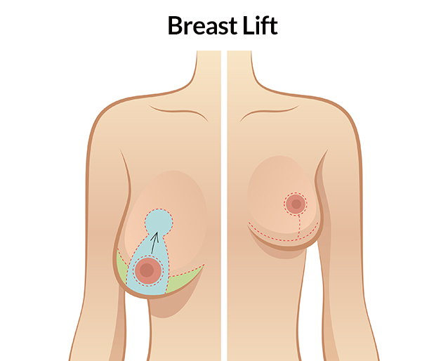 What Is the Best Age for a Breast Lift?