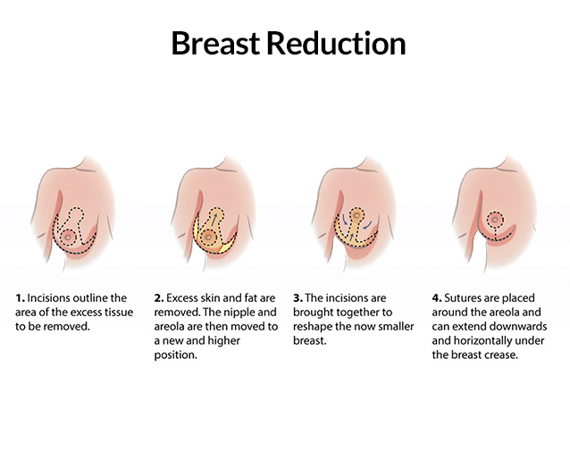 Will My Breasts Sag After Breast Reduction?