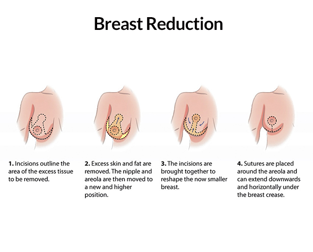  Breast Reduction