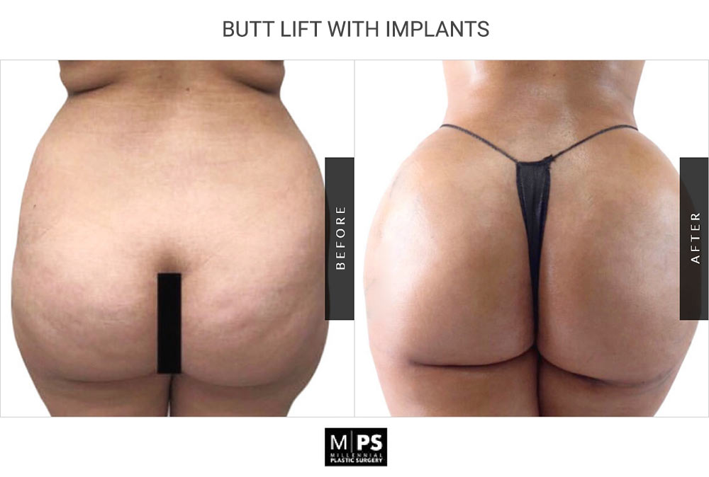 Butt Lift With Implants