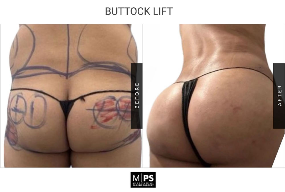 Buttock Lift