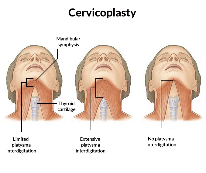 Cervicoplasty