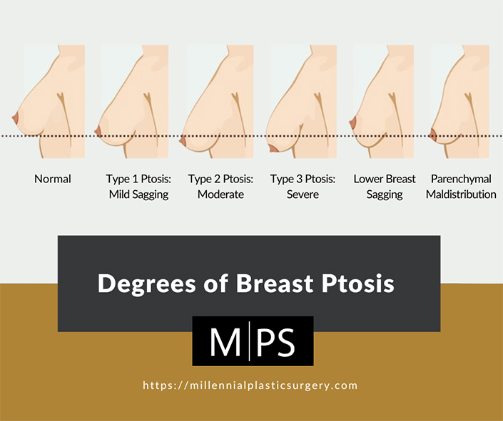 Degrees of Breast Ptosis