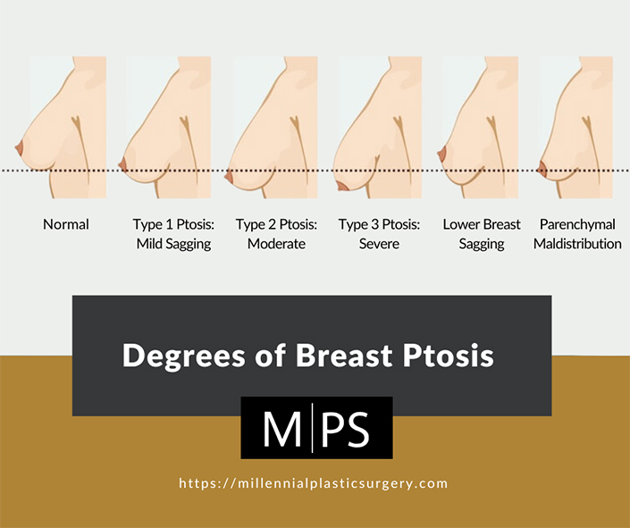 Increase breast size: 4 Natural ways without surgery