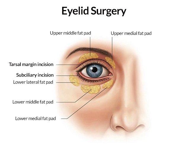 Eyelid Surgery