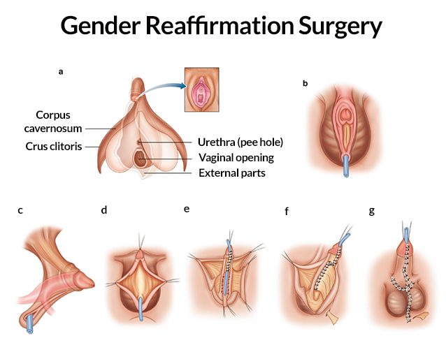 Gender Reaffirmation Surgery Anatomy