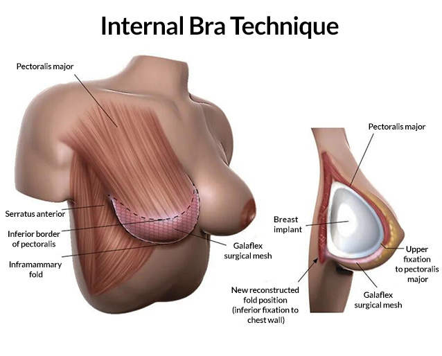 Reasons for Breast Lift Surgery with Internal Bra Technique