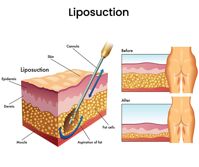 How Much Does Liposuction Cost?