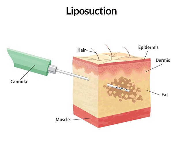 Is AirSculpt Liposuction Better?