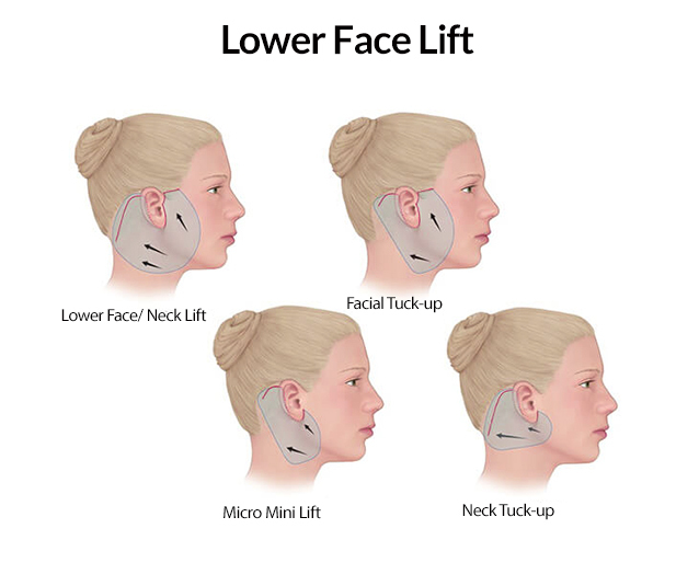 Lower Face-Lift