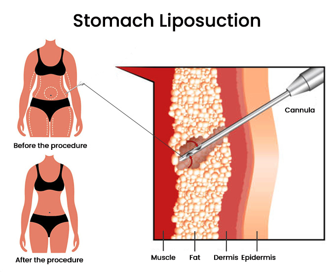 Cost Of Liposuction Austin