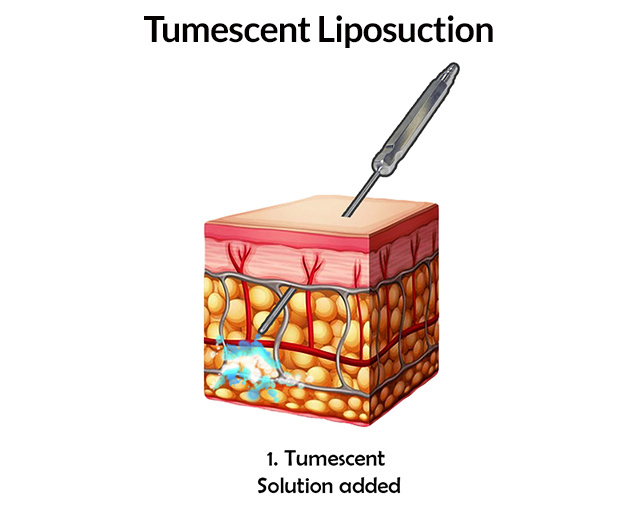 Tumescent Liposuction