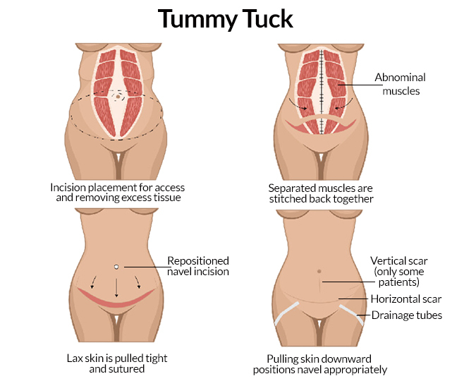 Tummy Tuck Anatomy