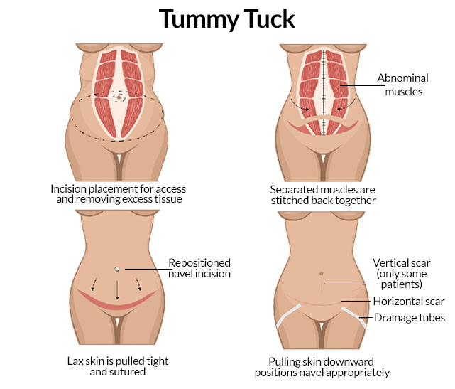 Physical Activity And Sex After Plastic Surgery