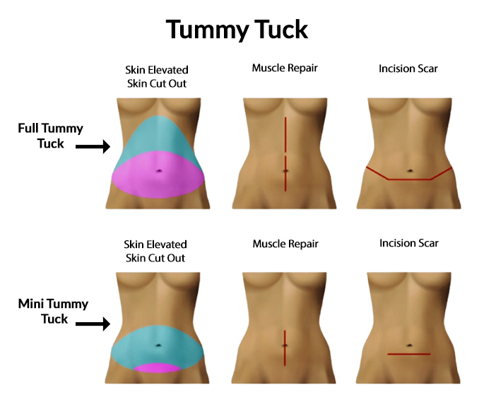 Liposuction vs. Tummy Tuck: Things You Need to Know