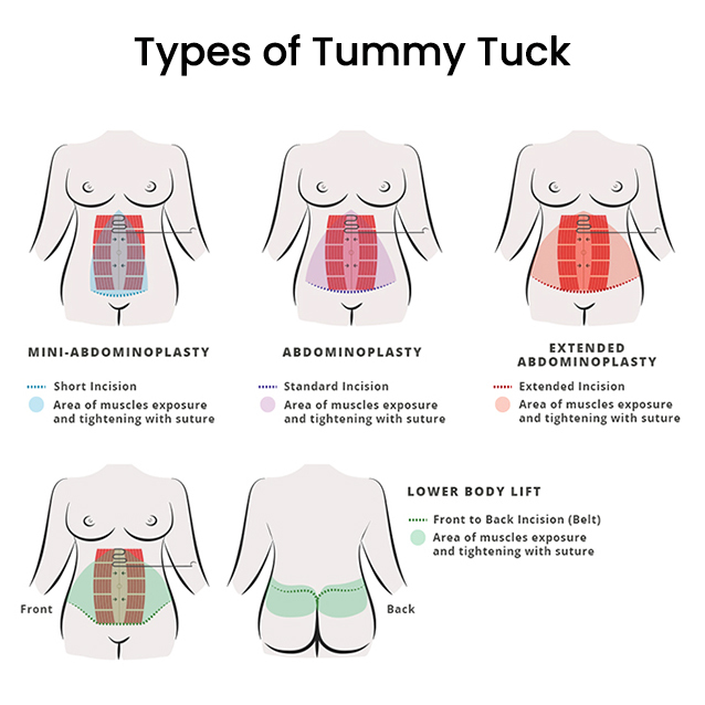 Types of Tummy Tuck