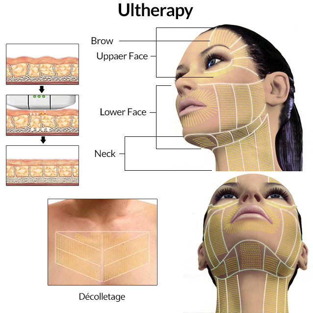 Ultherapy