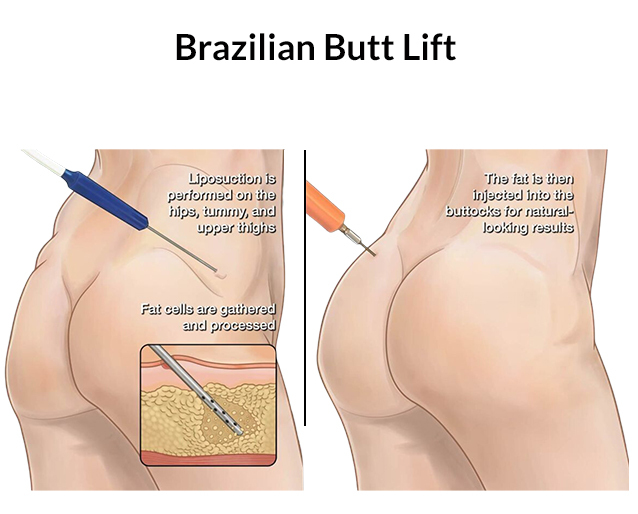 Brazilian butt lift