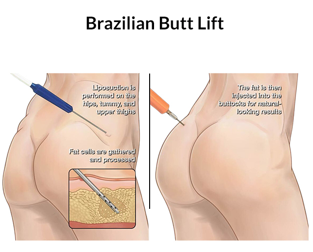 How Long Does It Take to Recover from a Brazilian Butt Lift?