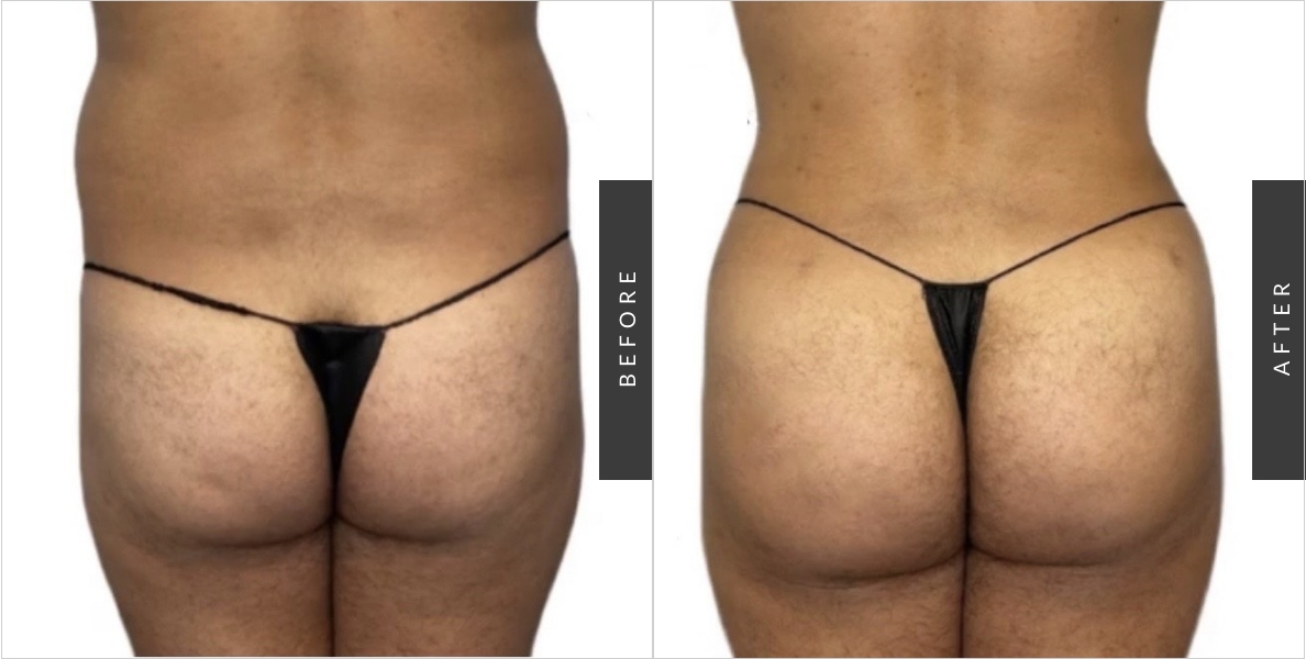 Buttock augmentation, sometimes referred to as a BBL or Brazilian Butt Lift  using your own fat or implants, can surgically increase the s