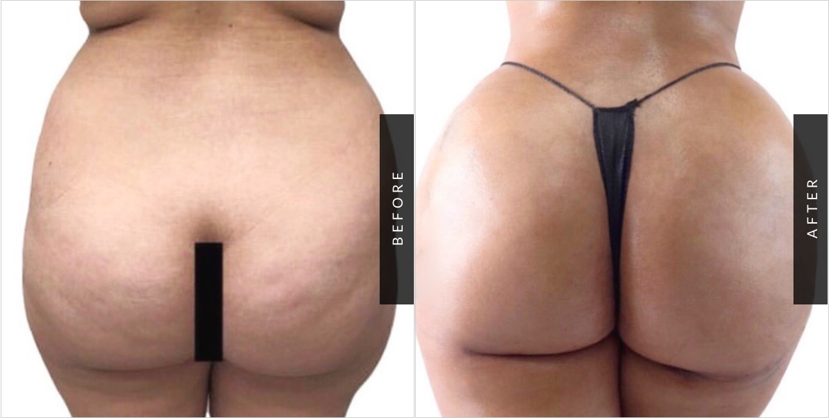Butt Reduction Before and After