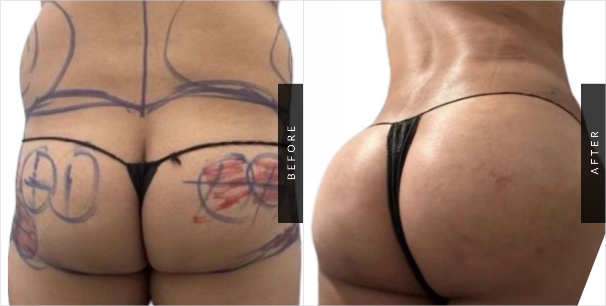 Buttocks Reduction Surgery Before & After