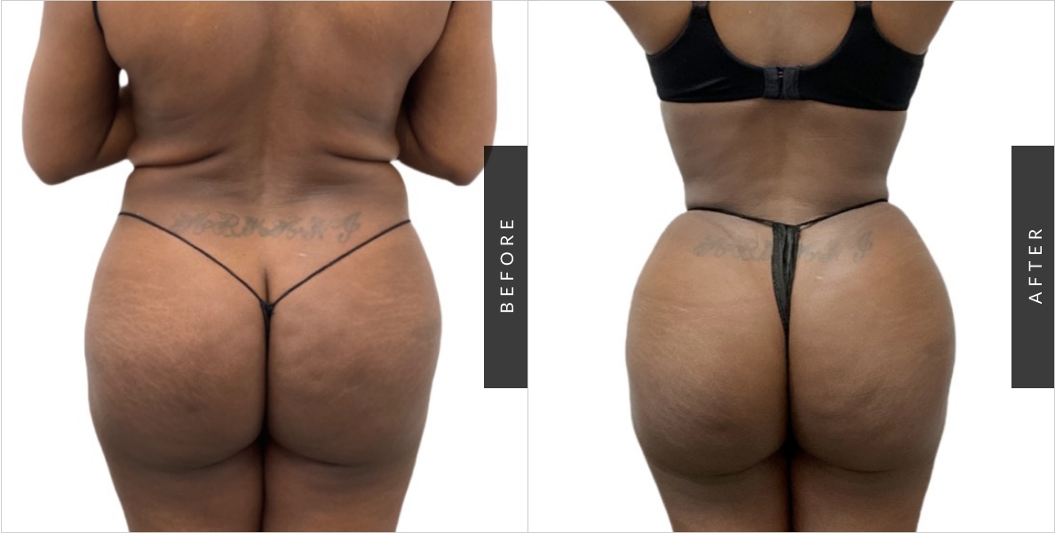 Butt Reduction Before & After