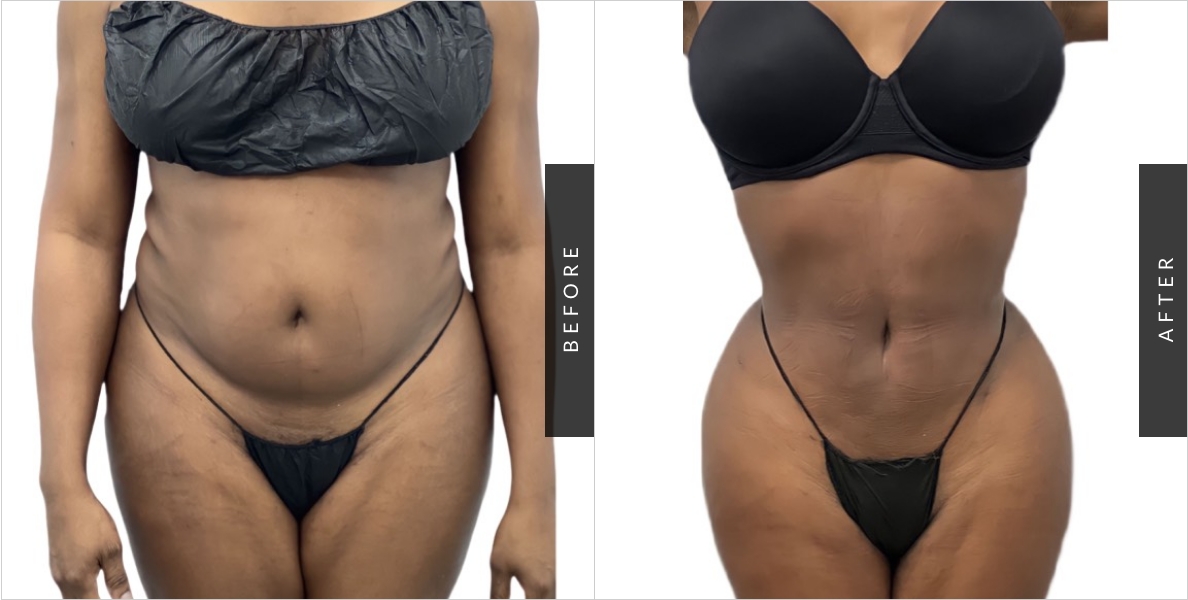 Brachzilian Butt Lift Before-
https://millennialplasticsurgery.com/wp-content/uploads/2023/06/butt-lift-0100.jpg