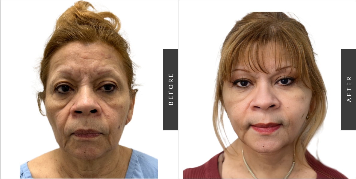 Facelift before & After